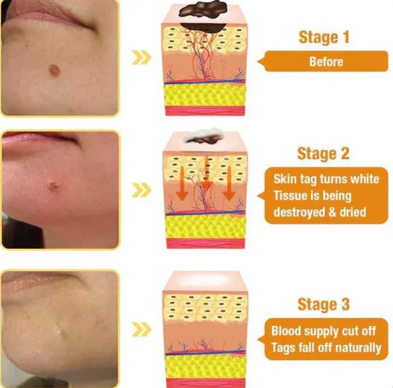 Bee Venom Skin Tag & Wart Remover Spray