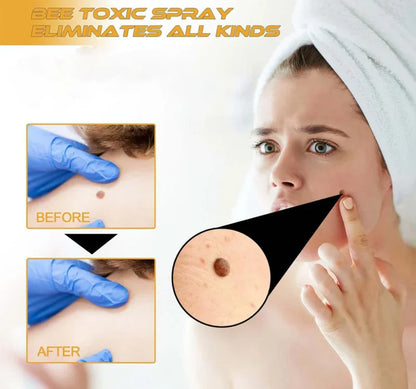 Bee Venom Skin Tag & Wart Remover Spray